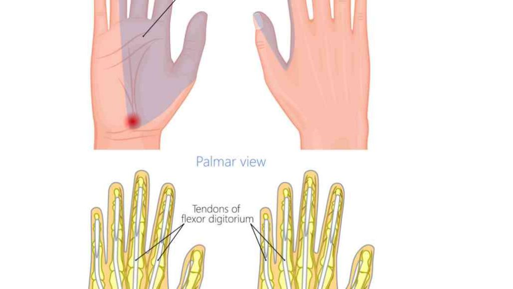 carpal tunnel graphic oa artboard 2 1030x580 1